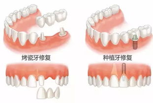 烤瓷牙品牌排行榜，打造完美笑容的优选之选