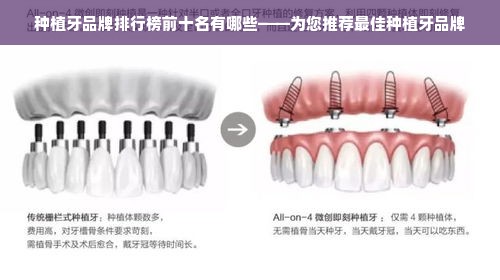 种植牙品牌排行榜前十名有哪些——为您推荐最佳种植牙品牌
