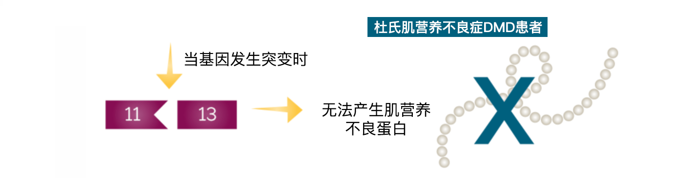 杜氏肌肉营养不良症 杜氏肌肉营养不良症有什么特效药根治吗