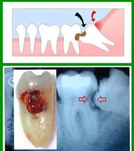 智齿为什么疼 智齿为什么疼到都麻了