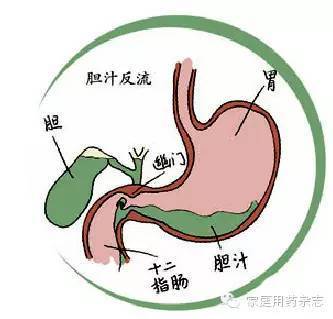 为什么会反流 胃食管为什么会反流