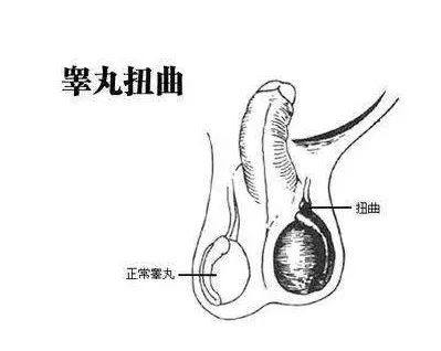 刚出生男婴儿睾丸图片 刚出生的男宝宝蛋蛋有多大