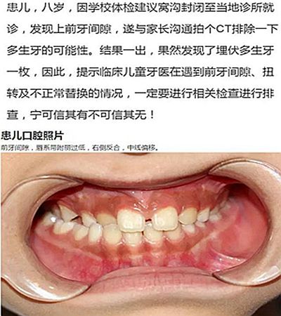 多生牙运势(多生牙的人命好吗)